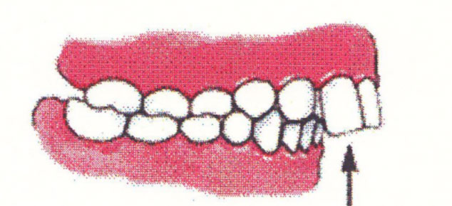 Ortodontia interceptivă