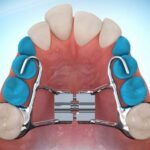 disjunctor copii aparate dentare ortodont bucuresti