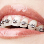 Remedii pentru durerile cauzate de aparatul dentar