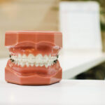 Despre brackeți si arcul ortodontic - cele 2 componente importante ale aparatului ortodontic