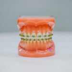 Aparat-dentar-realizare-tratament-ortodontic